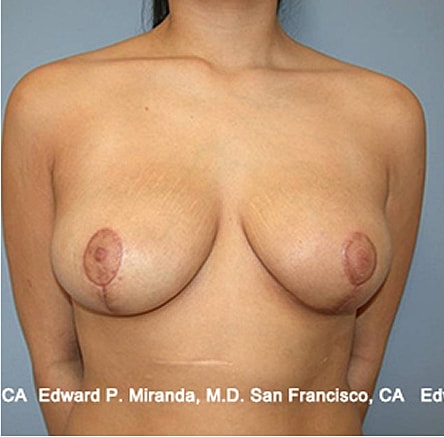 Breast Lift Before & After