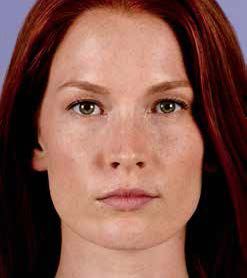 Juvederm Before & After