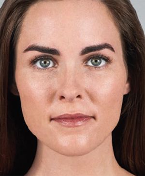 Juvederm Before & After