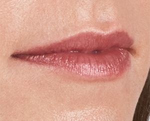 Juvederm Before & After