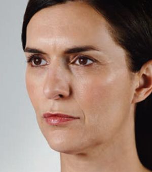 Juvederm Before & After