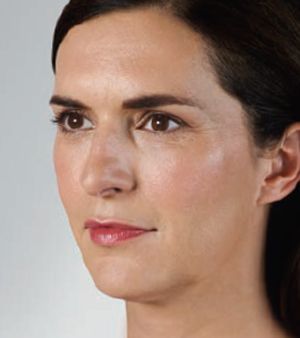 Juvederm Before & After