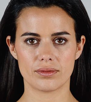 Juvederm Before & After