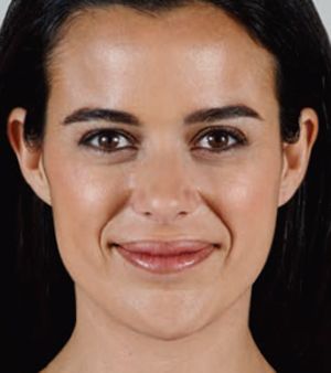 Juvederm Before & After