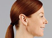 Juvederm Before & After