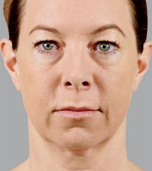 Juvederm Before & After