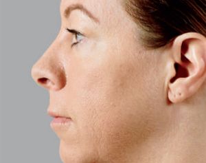 Juvederm Before & After