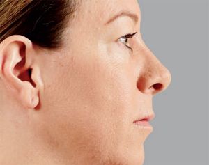 Juvederm Before & After