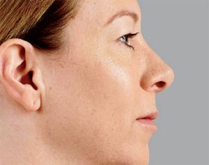 Juvederm Before & After