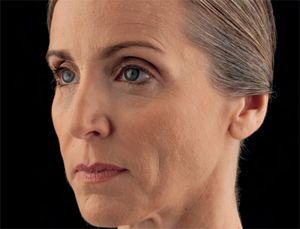 Juvederm Before & After