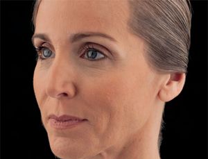 Juvederm Before & After