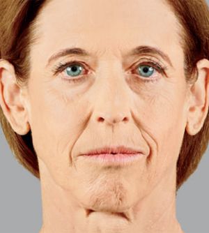 Juvederm Before & After