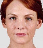 Juvederm Before & After