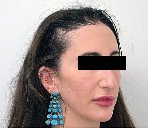 Hairline Lowering Before & After