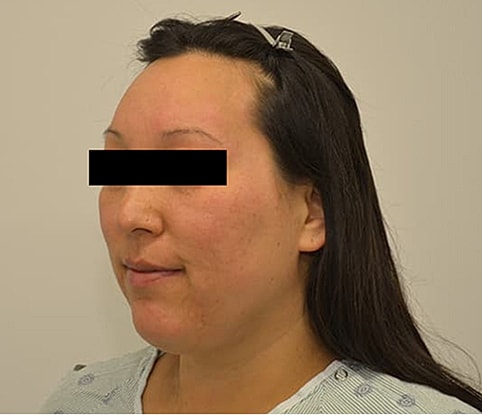 Hairline Lowering Before & After