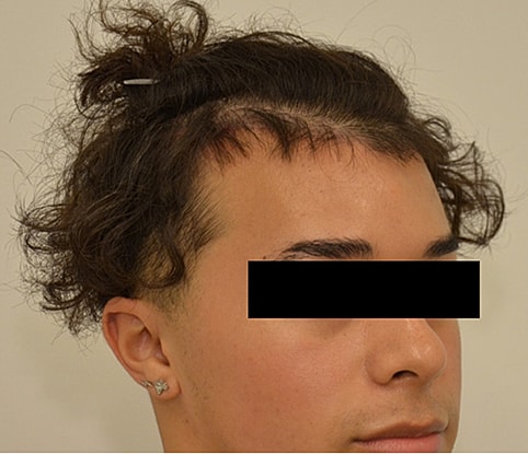 Hairline Lowering Before & After