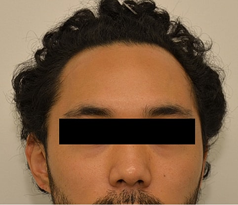 Hairline Lowering Before & After