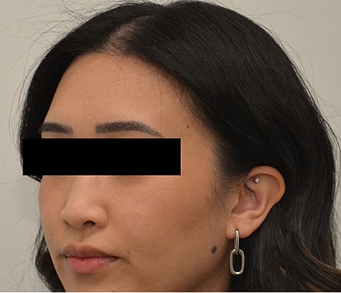 Hairline Lowering Before & After