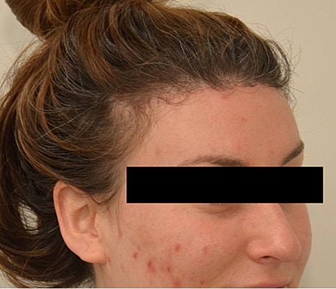 Hairline Lowering Before & After