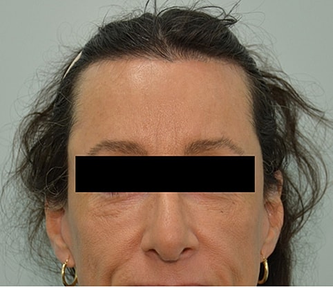 Hairline Lowering Before & After