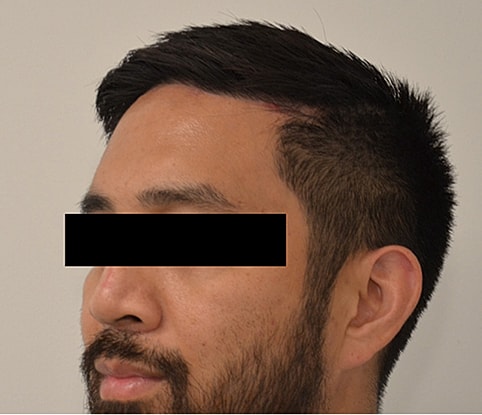 Hairline Lowering Before & After