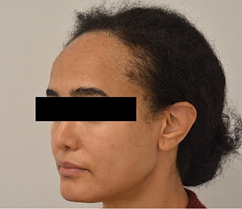 Hairline Lowering Before & After