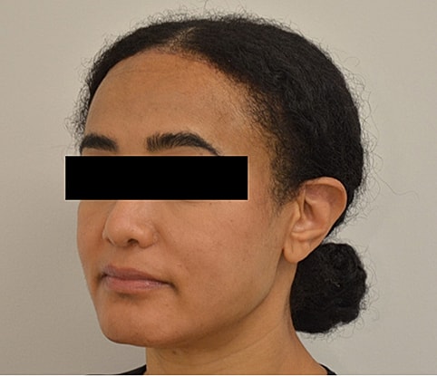 Hairline Lowering Before & After