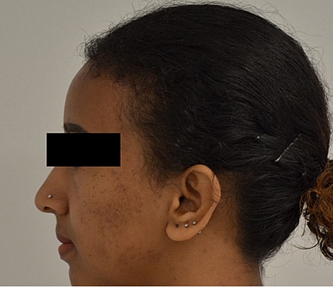 Hairline Lowering Before & After