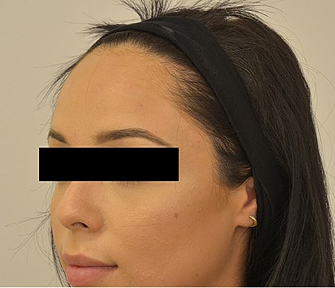 Hairline Lowering Before & After