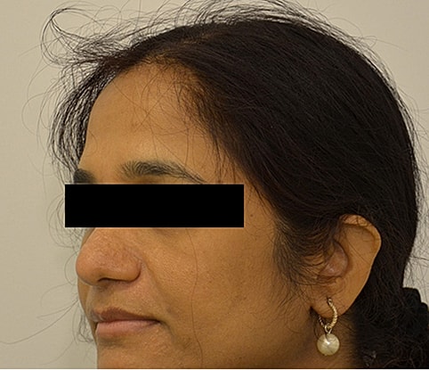 Hairline Lowering Before & After