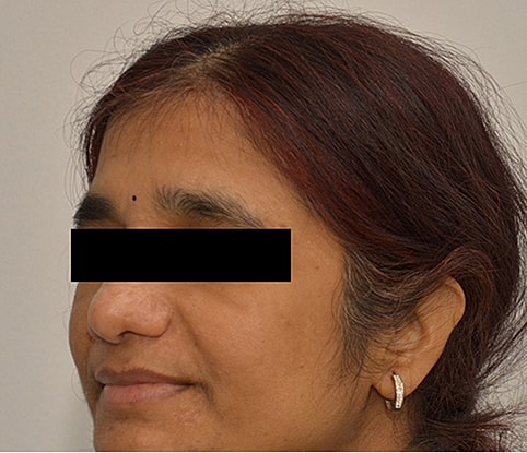 Hairline Lowering Before & After