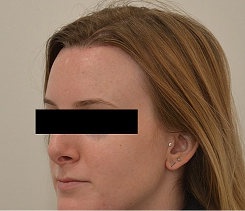 Hairline Lowering Before & After