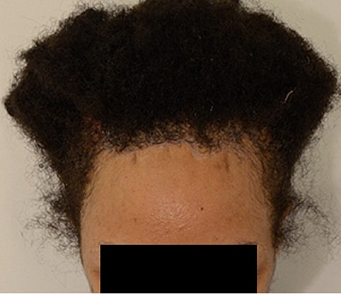 Hairline Lowering Before & After