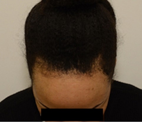Hairline Lowering Before & After