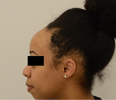 Hairline Lowering Before & After