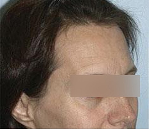 Hairline Lowering Before & After