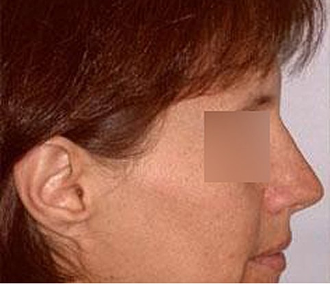 Hairline Lowering Before & After