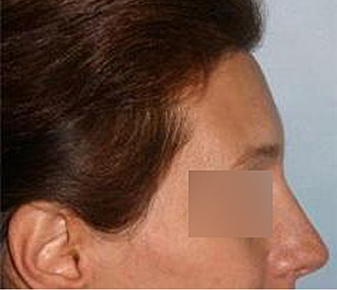 Hairline Lowering Before & After