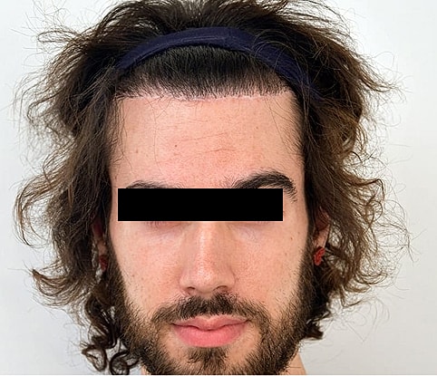 Hairline Lowering Before & After