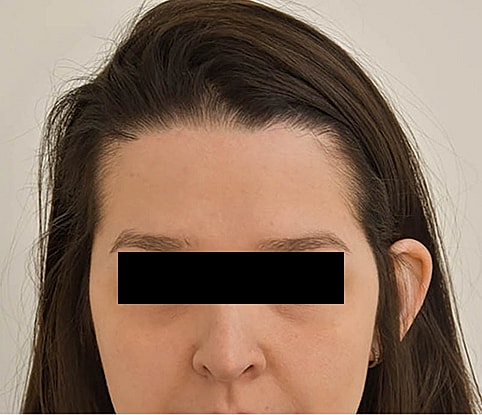 Hairline Lowering Before & After