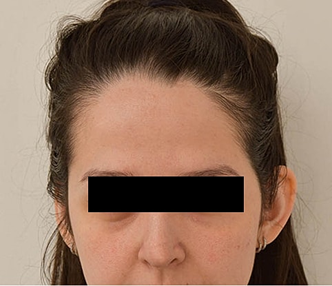 Hairline Lowering Before & After