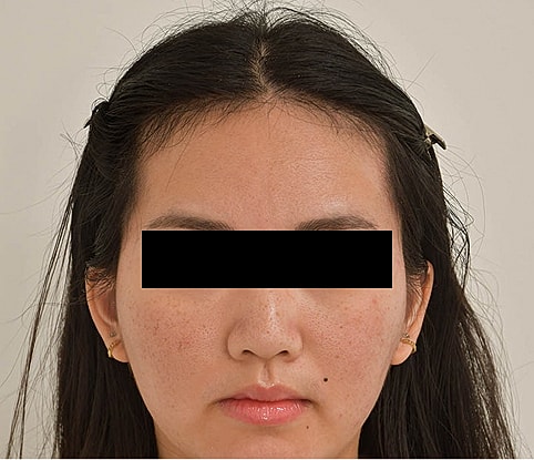 Hairline Lowering Before & After