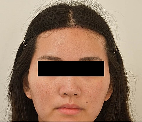 Hairline Lowering Before & After