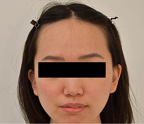 Hairline Lowering Before & After