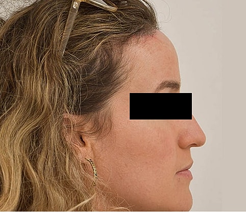 Hairline Lowering Before & After