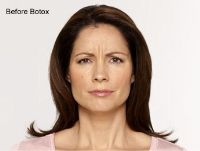 Dermal Fillers Before & After