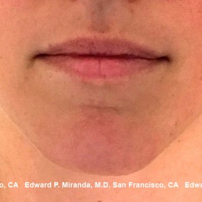 Dermal Fillers Before & After