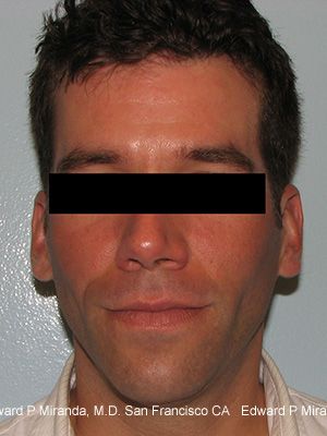 Dermal Fillers Before & After