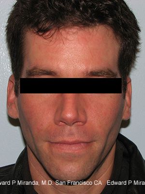 Dermal Fillers Before & After