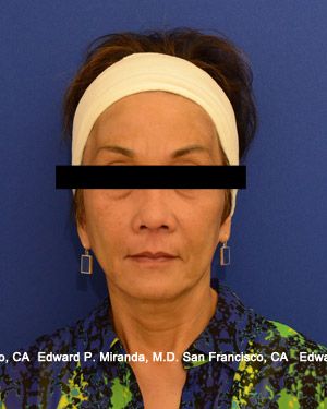 Dermal Fillers Before & After